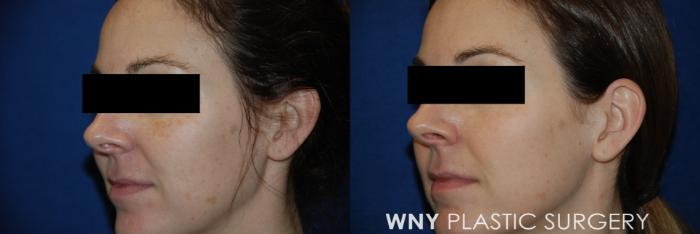 Before & After Laser Treatments Case 103 Left Side View in Williamsville, NY