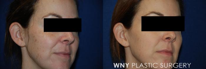 Before & After Laser Treatments Case 103 Right Side View in Williamsville, NY