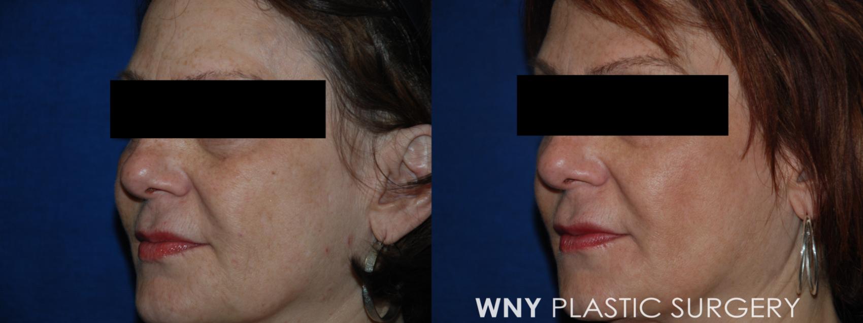 Before & After Laser Treatments Case 149 Left Side View in Buffalo, NY