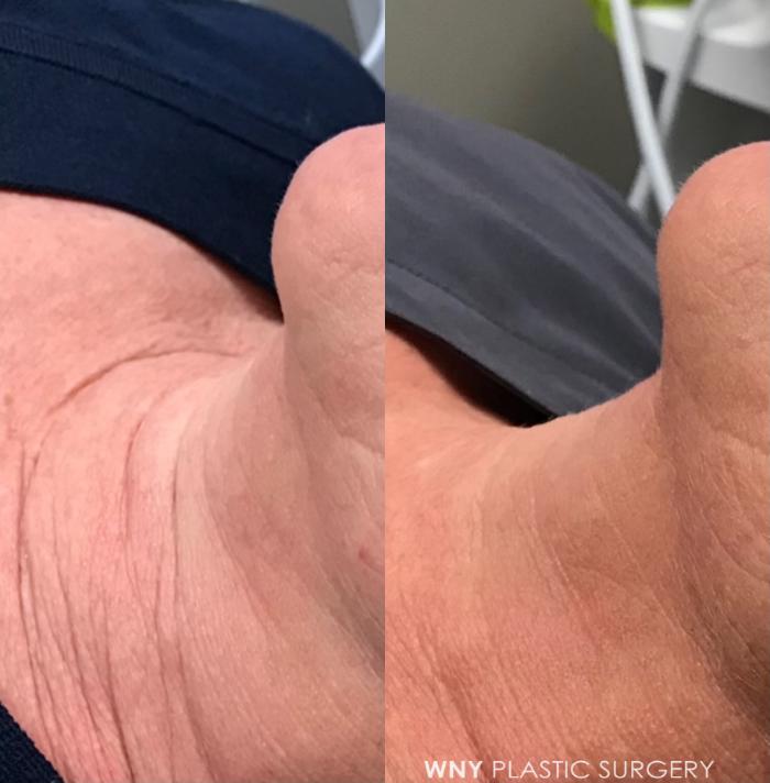 Before & After Skin Treatments Case 208 Left Oblique View in Williamsville, NY