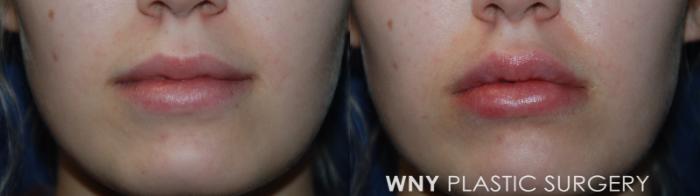 Before & After Lip Augmentation Case 101 Front View in Williamsville, NY