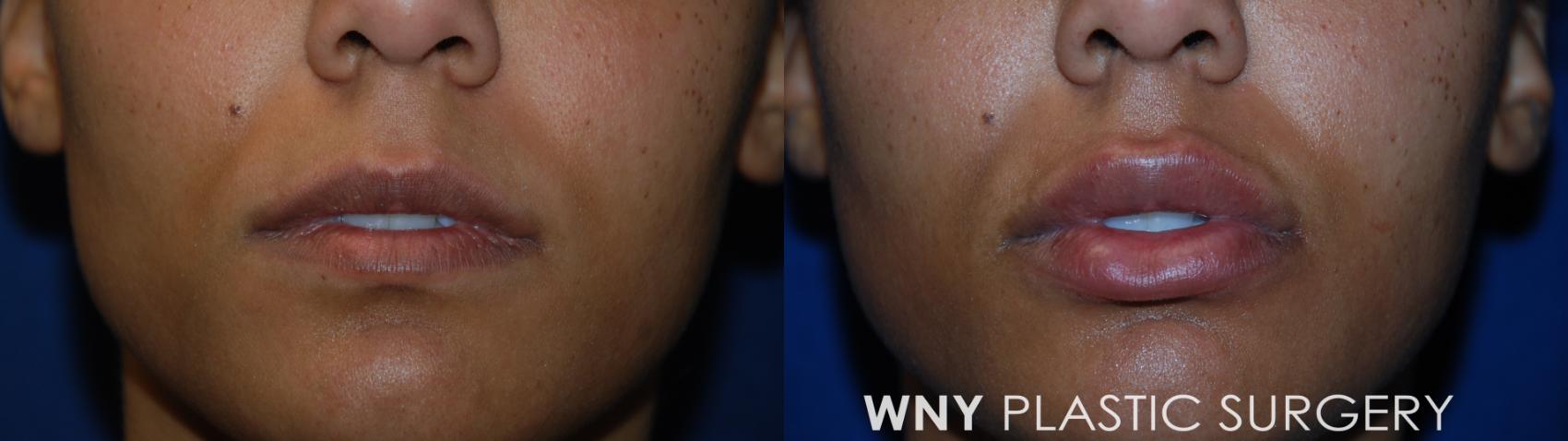 Before & After Lip Augmentation Case 102 Front View in Williamsville, NY