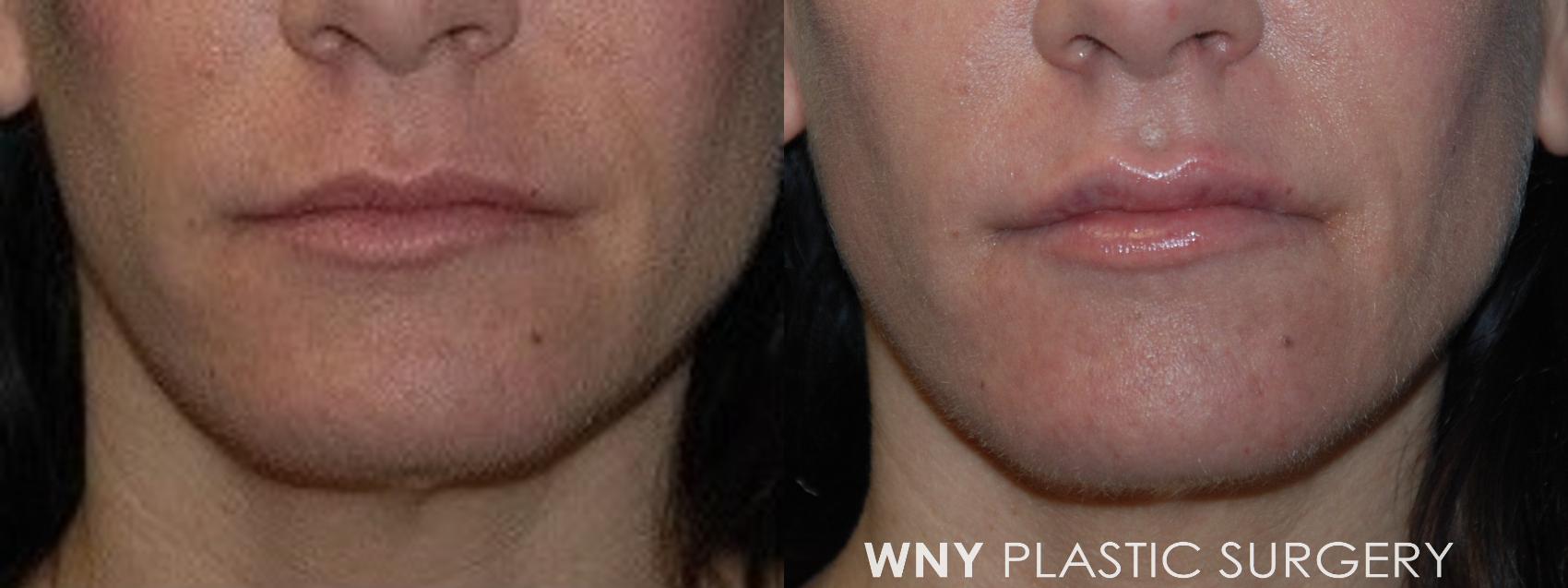 Before & After Lip Augmentation Case 129 Front View in Buffalo, NY