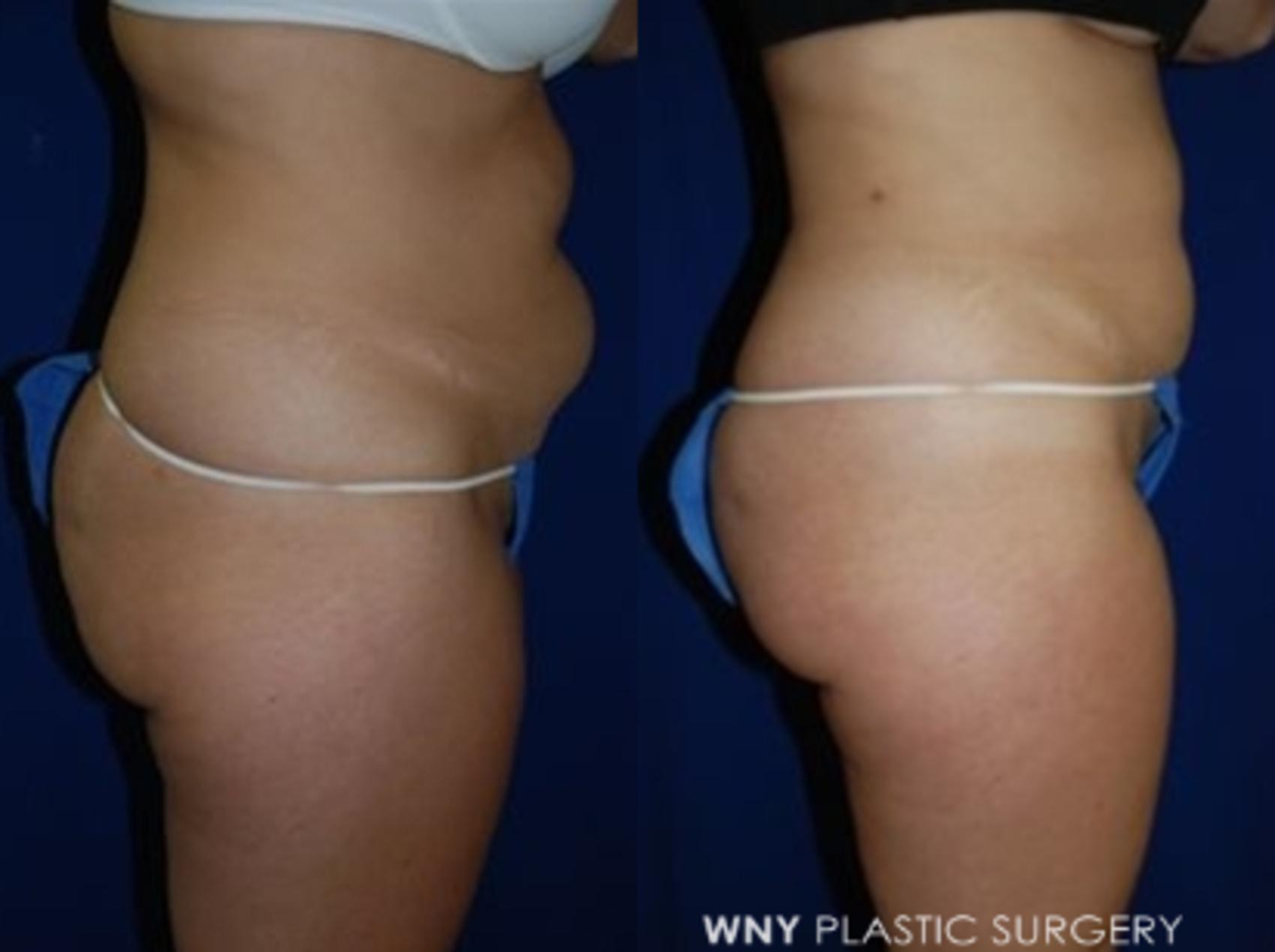 Before & After Liposuction Case 13 Right Side View in Williamsville, NY