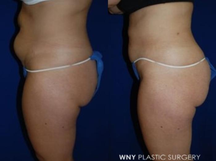 Before & After Liposuction Case 13 View #2 View in Buffalo, NY