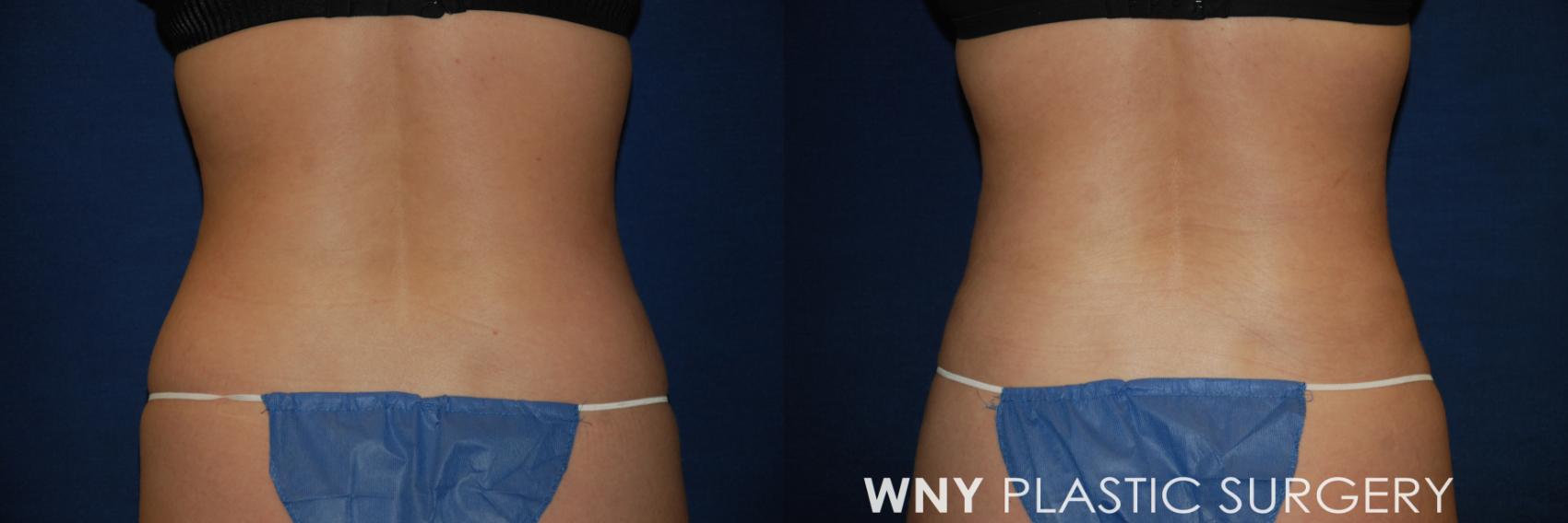 Before & After Liposuction Case 167 Back View in Williamsville, NY