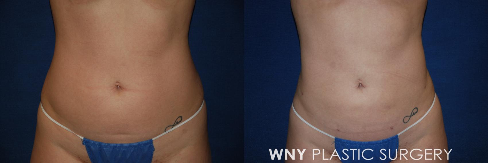 Before & After Liposuction Case 167 Front View in Williamsville, NY