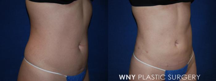Before & After Liposuction Case 167 Right Oblique View in Williamsville, NY