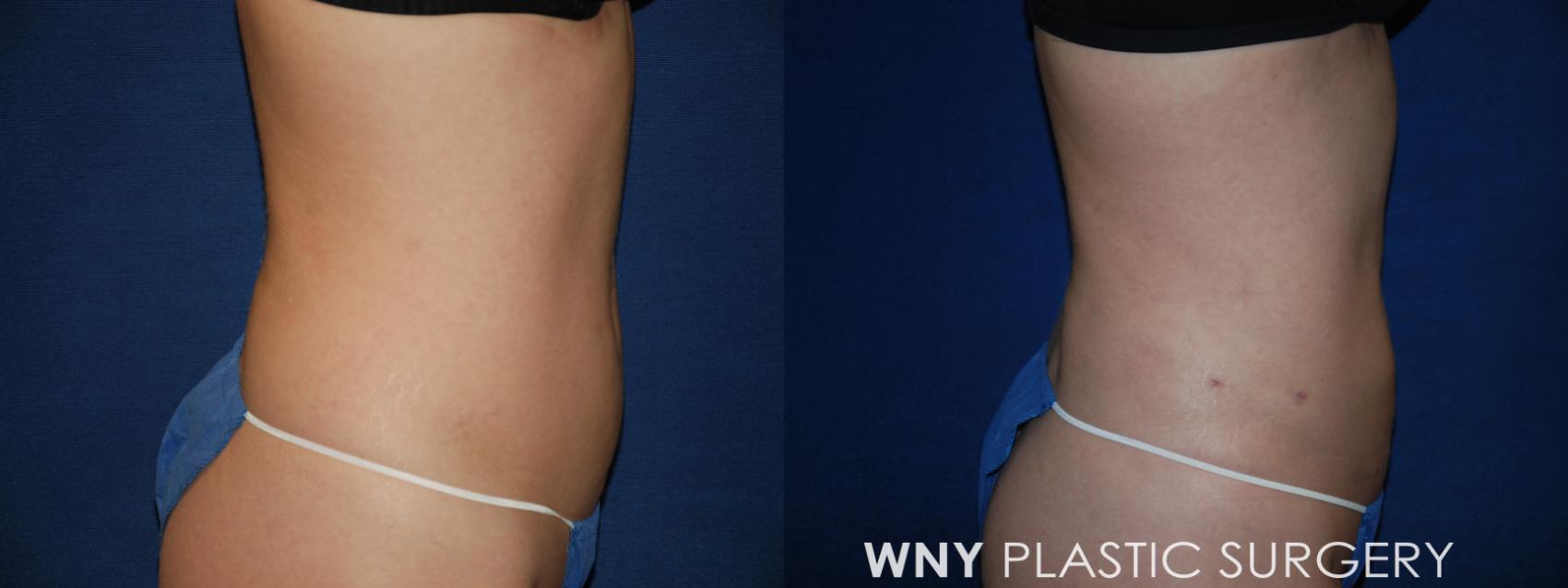 Before & After Liposuction Case 167 Right Side View in Williamsville, NY