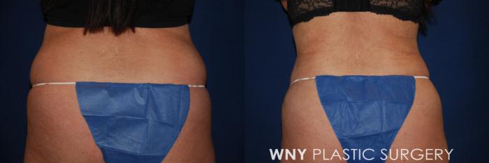Before & After Liposuction Case 175 Back View in Williamsville, NY
