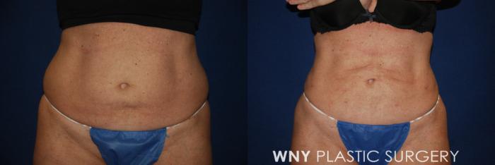 Before & After Liposuction Case 175 Front View in Williamsville, NY