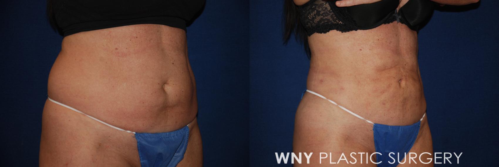 Before & After Liposuction Case 175 Right Oblique View in Williamsville, NY