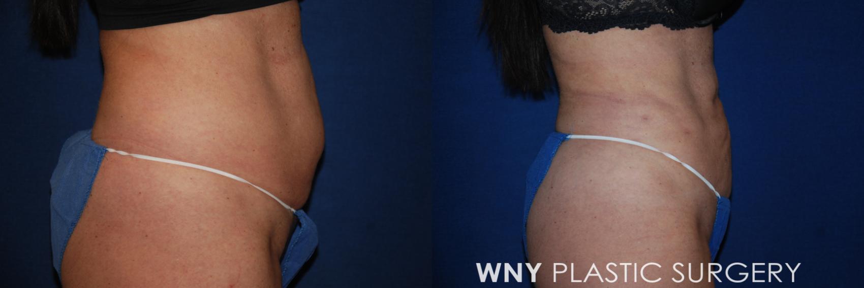 Before & After Liposuction Case 175 Right Side View in Williamsville, NY