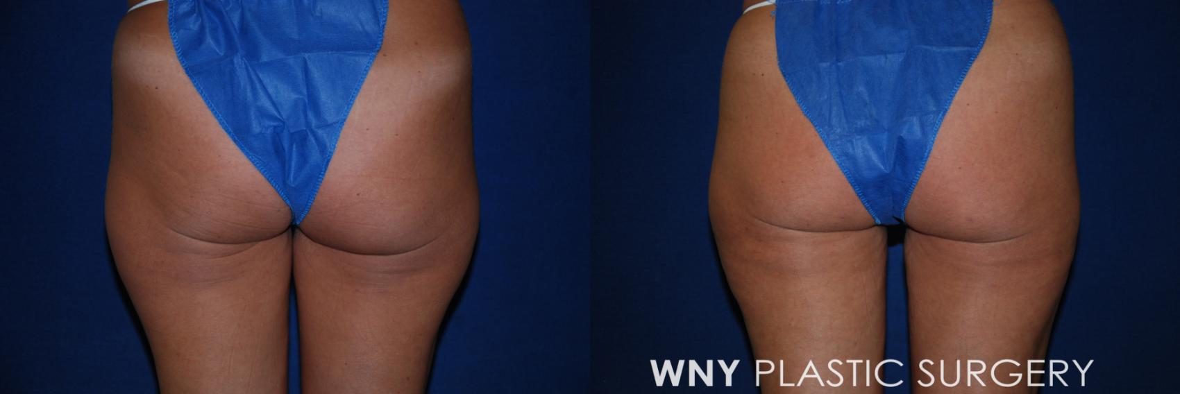 Before & After Liposuction Case 176 Back View in Williamsville, NY