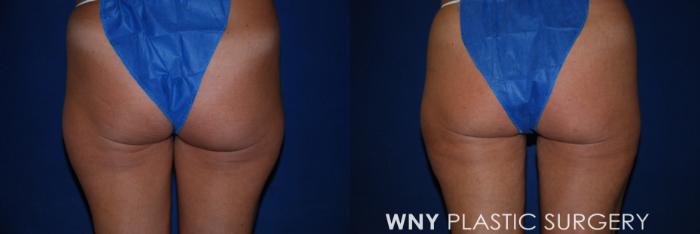 Before & After Liposuction Case 176 Back View in Buffalo, NY