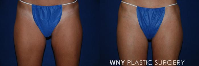 Before & After Liposuction Case 176 Front View in Buffalo, NY