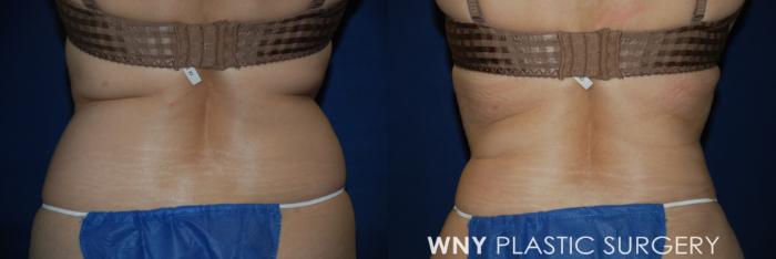 Before & After Liposuction Case 179 Back View in Buffalo, NY