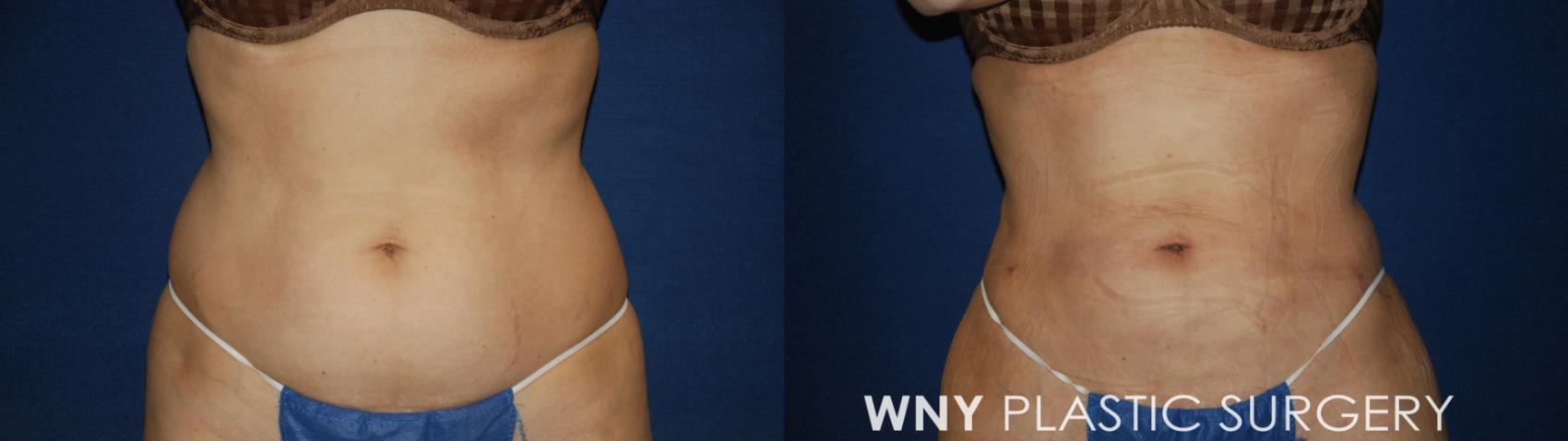 Before & After Liposuction Case 179 Front View in Williamsville, NY