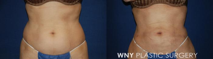 Before & After Liposuction Case 179 Front View in Buffalo, NY