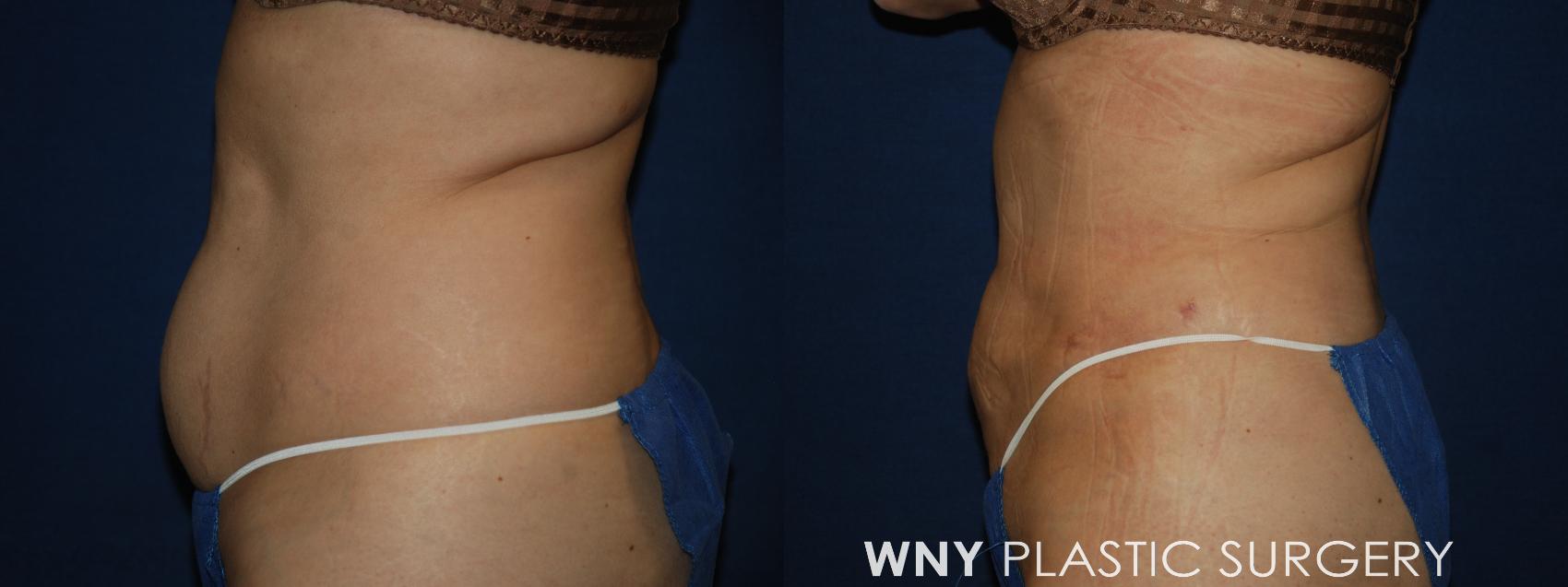 Before & After Liposuction Case 179 Left Side View in Williamsville, NY