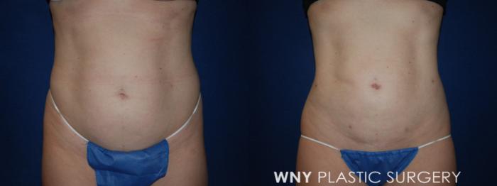Before & After Liposuction Case 190 Front View in Williamsville, NY