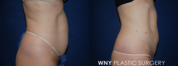 Before & After Liposuction Case 190 Right Side View in Williamsville, NY