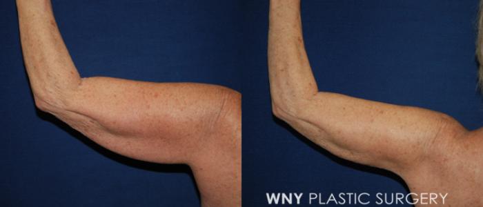 Before & After Liposuction Case 196 Left Back View in Buffalo, NY