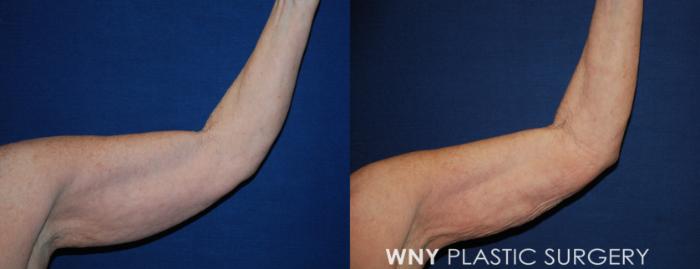 Before & After Liposuction Case 196 Left Front View in Buffalo, NY