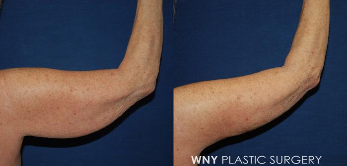Before & After Liposuction Case 196 Right Back View in Buffalo, NY