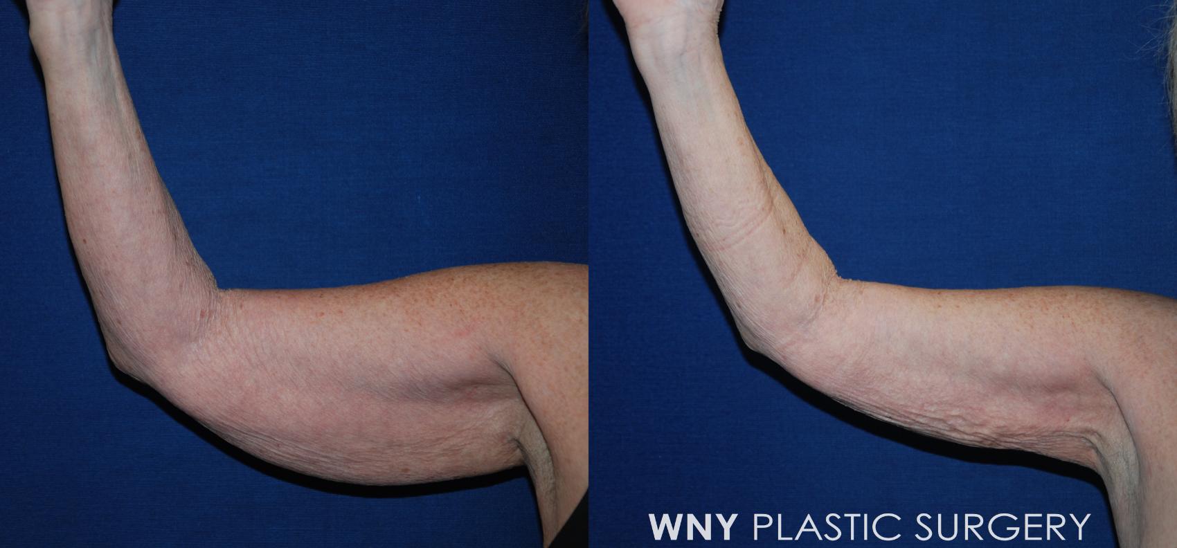 Before & After Liposuction Case 196 Right Front View in Williamsville, NY