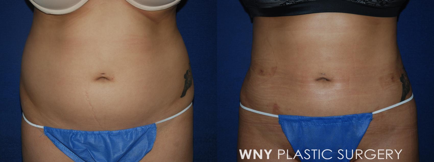 Before & After Liposuction Case 38 Front View in Williamsville, NY