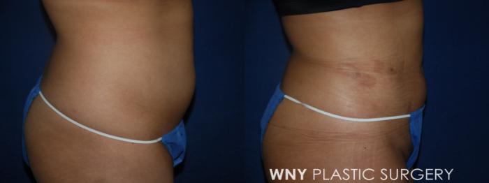 Before & After Liposuction Case 38 Right Side View in Williamsville, NY