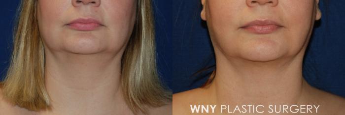 Before & After Liposuction Case 59 Front View in Buffalo, NY