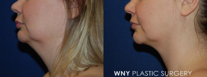 Before & After Liposuction Case 59 Left Side View in Buffalo, NY