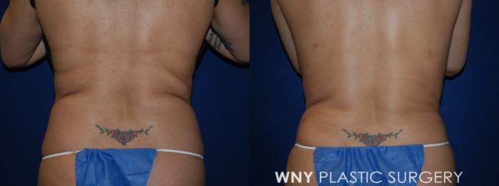 Before & After Liposuction Case 68 Back View in Williamsville, NY