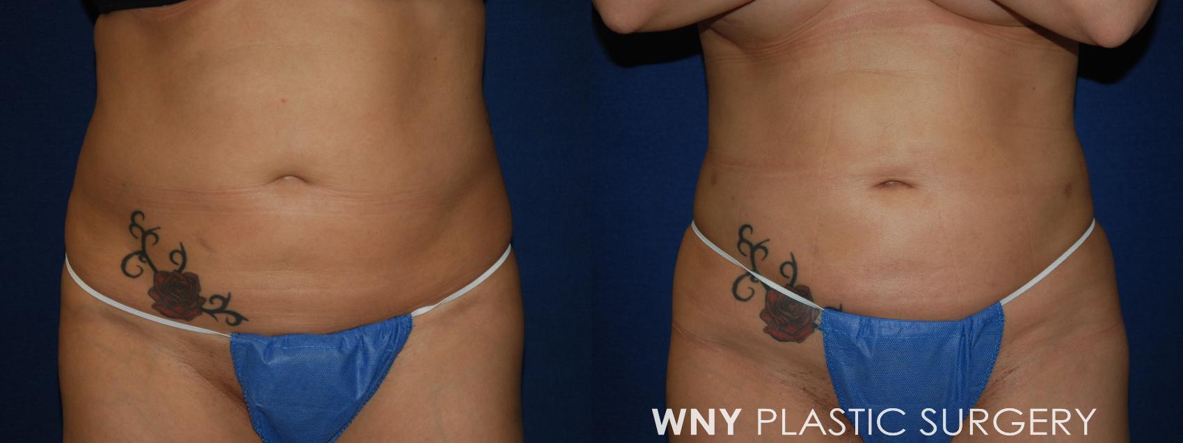 Before & After Liposuction Case 68 Front View in Williamsville, NY