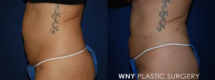 Before & After Liposuction Case 68 Left Side View in Williamsville, NY