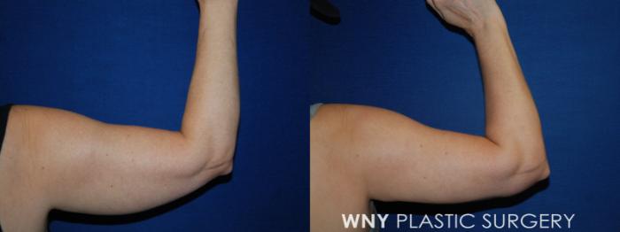 Before & After Liposuction Case 69 Back View in Buffalo, NY