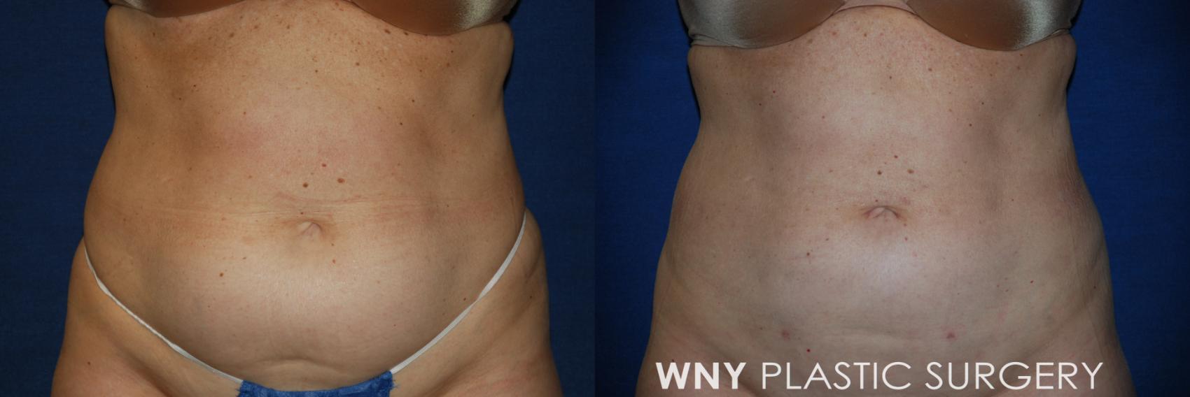 Before & After Liposuction Case 97 Front View in Williamsville, NY