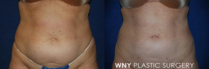 Before & After Liposuction Case 97 Front View in Buffalo, NY