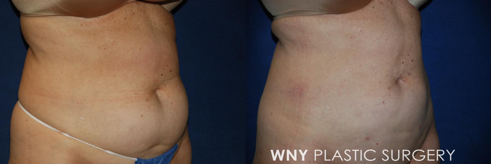 Before & After Liposuction Case 97 Right Oblique View in Williamsville, NY