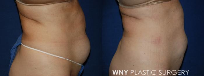 Before & After Liposuction Case 97 Right Side View in Williamsville, NY