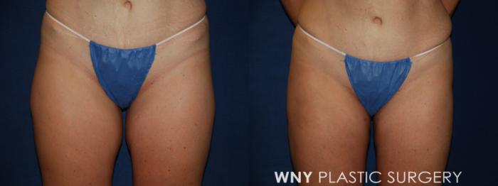 Before & After Liposuction Case 98 Front View in Buffalo, NY