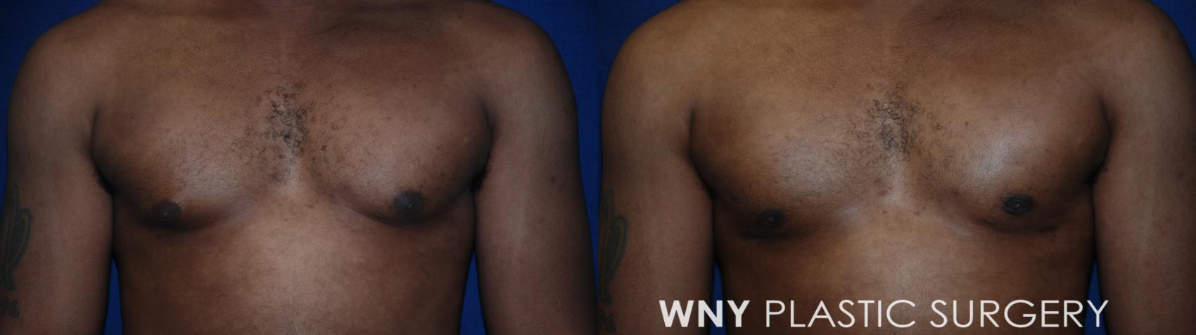 Before & After Male Breast Reduction Case 182 Front View in Buffalo, NY