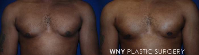 Before & After Male Breast Reduction Case 182 Front View in Williamsville, NY