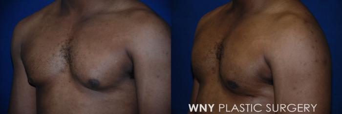 Before & After Male Breast Reduction Case 182 Left Oblique View in Williamsville, NY