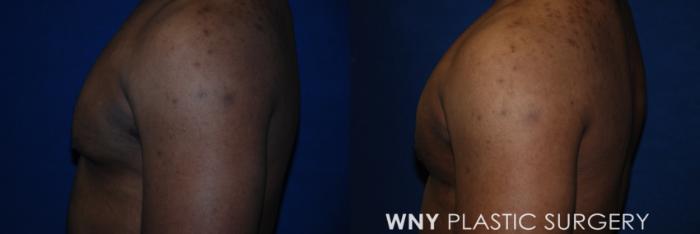 Before & After Male Breast Reduction Case 182 Left Side View in Williamsville, NY