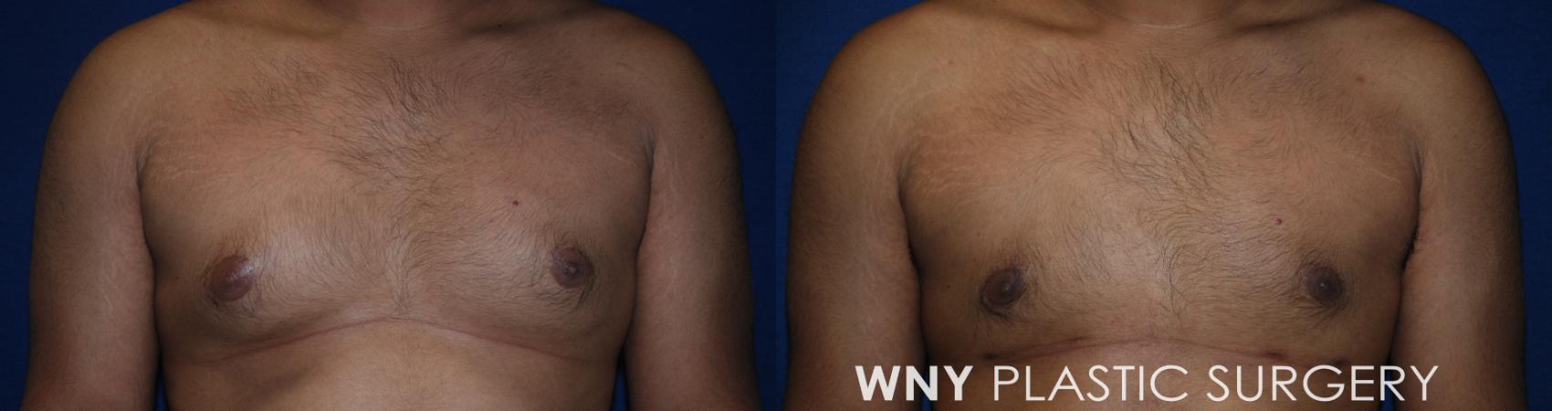 Before & After Liposuction Case 184 Front View in Williamsville, NY