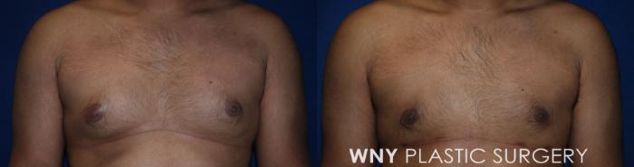 Before & After Male Breast Reduction Case 184 Front View in Williamsville, NY