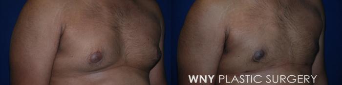 Before & After Male Breast Reduction Case 184 Right Oblique View in Buffalo, NY